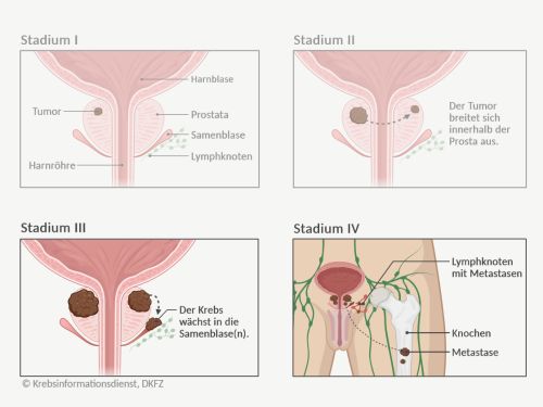 Graphische Darstellung der 4 Tumorstadien bei Prostatakrebs und die unterschiedliche Tumorgröße und Ausbreitung im Körper.