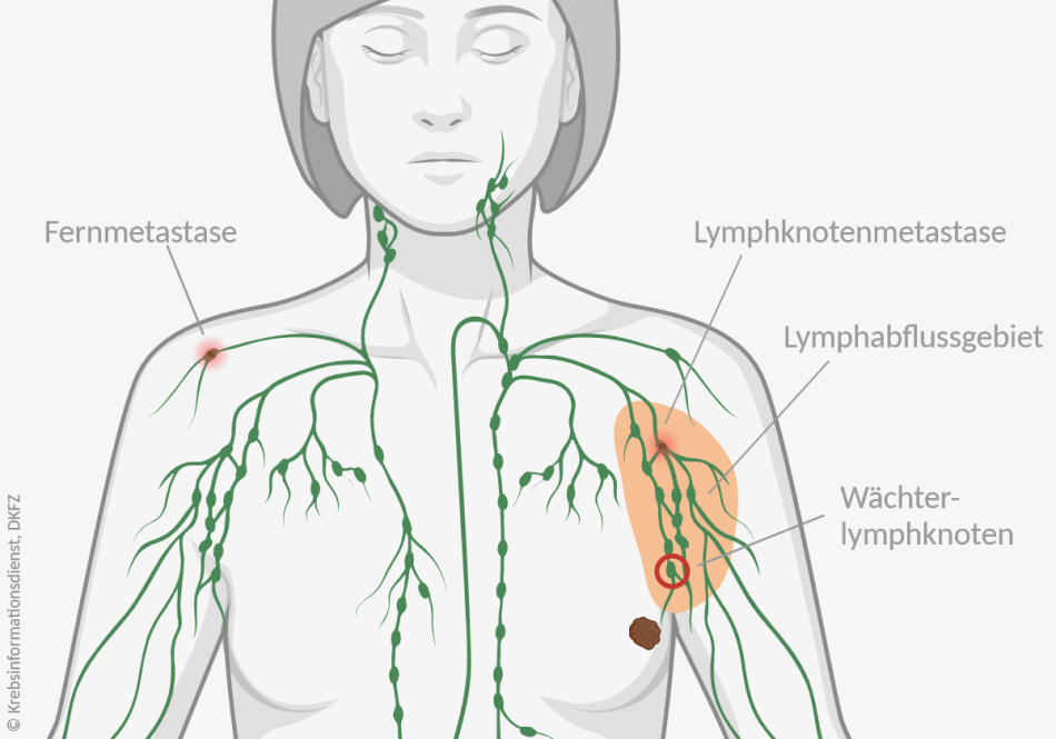 Grafik eines weiblichen Oberkörpers mit einem Tumor in der linken Brust. Das Lymphabflussgebiet ist markiert, darin ist eine Lymphknotenmetastase eingezeichnet. In der entfernten, rechten Schulter ist eine Fernmetastase in einem Lymphknoten dargestellt.