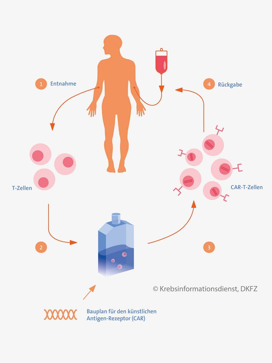 Prinzip einer CAR-T-Zell-Therapie. © Krebsinformationsdienst, Deutsches Krebsforschungszentrum